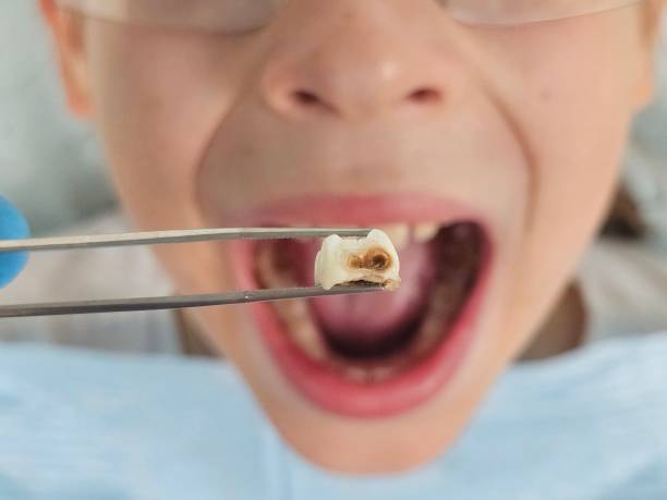 Best Knocked-Out Tooth (Avulsed Tooth) Treatment in Wink, TX